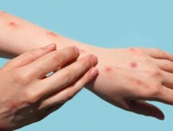 Catat! Begini Langkah Cegah Cara Cacar Monyet Menurut Pakar IDI